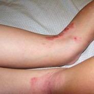 How To Handle Eczema The Smart Way
